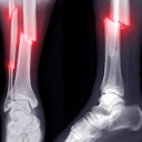 Fracture