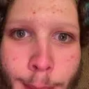 acnegolore