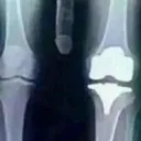 brokemyknee