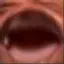 Wheeze_MV