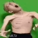 aneurysm