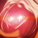 hypercalawheeze
