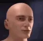 aneurysm