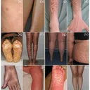 Ichthyosis