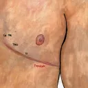 Top Surgery