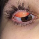 FLIPPING EYELID