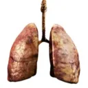 Pneumonoultramicroscopicsilicovolcanoconiosis FC