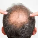 UncBaldspot Vault