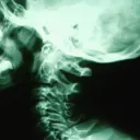 Temporo Mandibular Joint Disorder Sufferers Anonymous