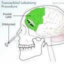 lobotomy's operation room