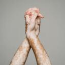 Dappled Dreamers: A Vitiligo Community Discord Server Icon